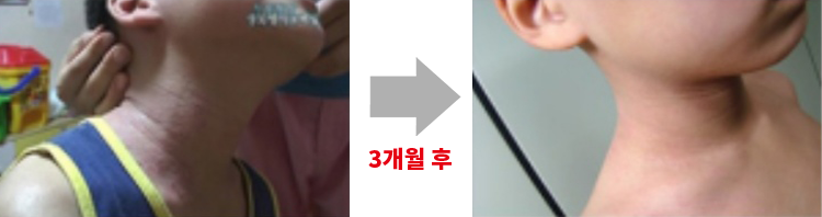 아토5분 사용 전/후 사진