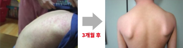아토5분 사용 전/후 사진