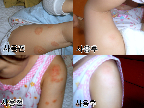 아토피 치료 - 아토7 사례 #1