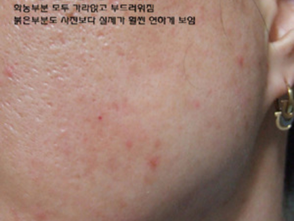 여드름에도 효과짱이네요.. 4일차 사진입니다