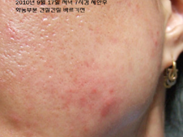 화농성 여드름에도 효과적인 아토7 너무놀랍습니다 ^^
