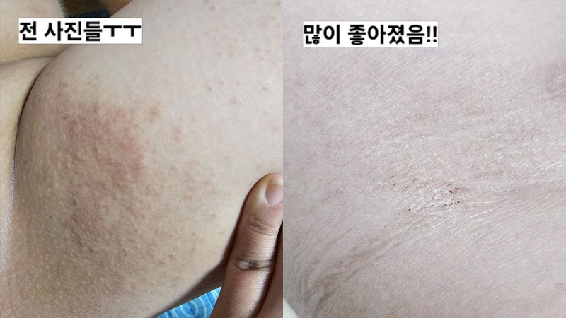 아토토피치료 중, 진정 케어에 도움을 준 '놀란바이오 아토5분' 사용 후기