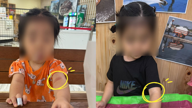 4살 아기 아토피 피부염 스테로이드 대체 천연 치료 후기 아토5분