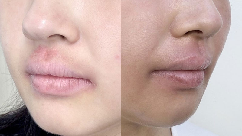 아토피 가려움 극복기 스테로이드 대체 가능 제품 아토5분 수성