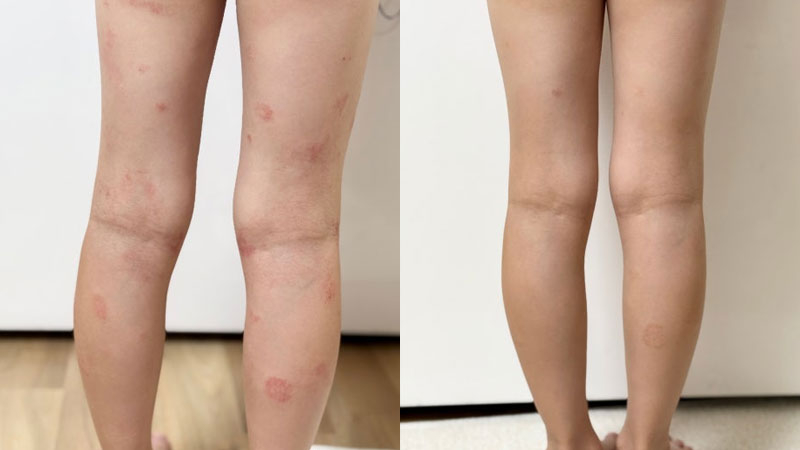 아토피 가려움 아토피 항균 제품 아토5분으로 가려움 사라짐 경험