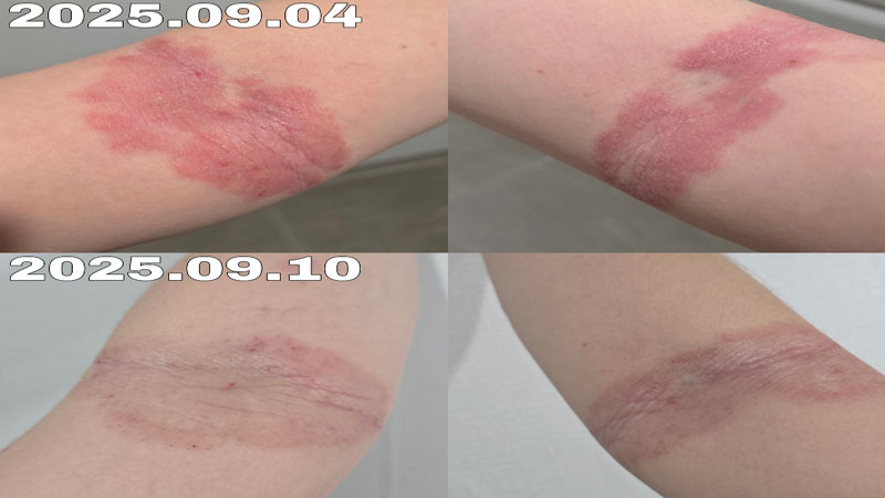 아토피 피부염 스테로이드 대체 보습제 아토5분 가려움 개선 솔직후기