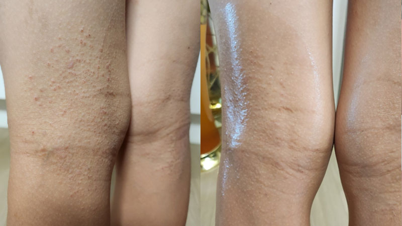 놀란바이오 아토5분 오일, 아토피 피부에 직접 써봤어요