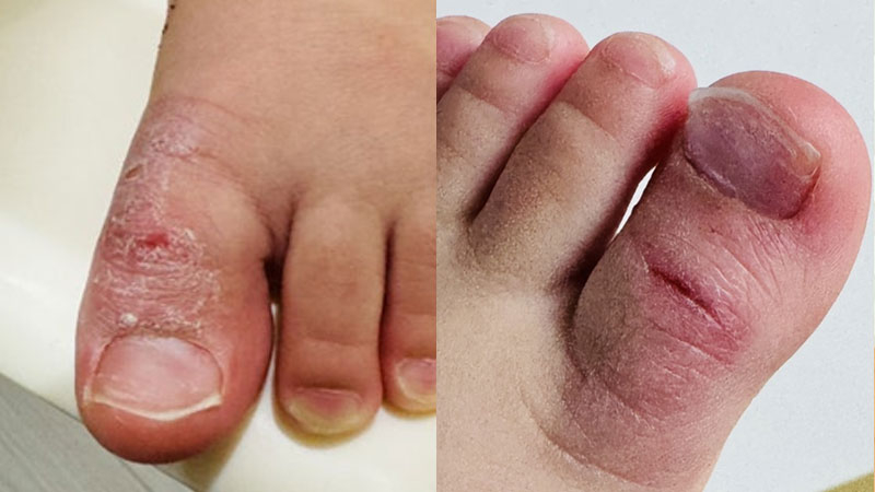 놀란바이오 아토5분 밤마다 긁는 아이