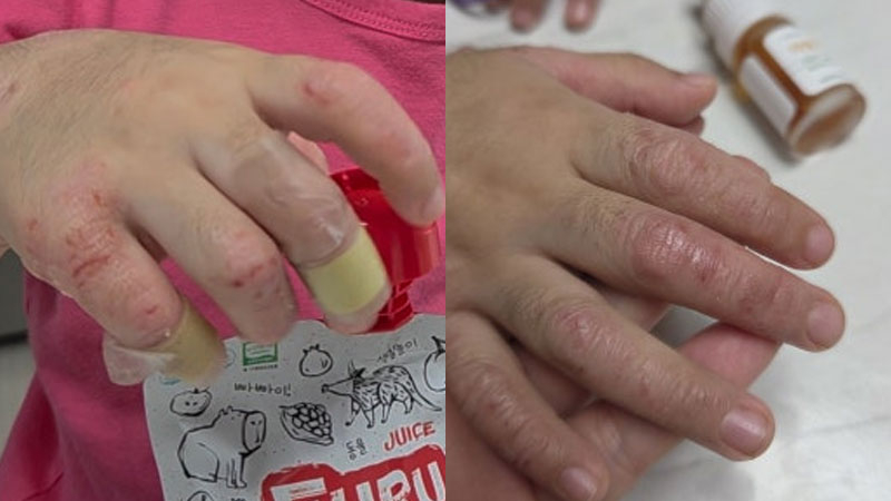 놀란바이오 아토5분 6세아기 아토피이겨내기 중