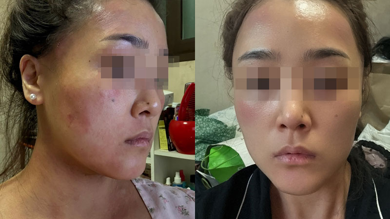 놀란바이오 아토5분 | 아토피 가려움증 극복 솔직 후기