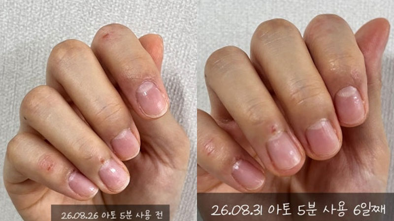 아토피 고민 끝 놀란바이오의 아토5분 직접 써본 솔직 후기